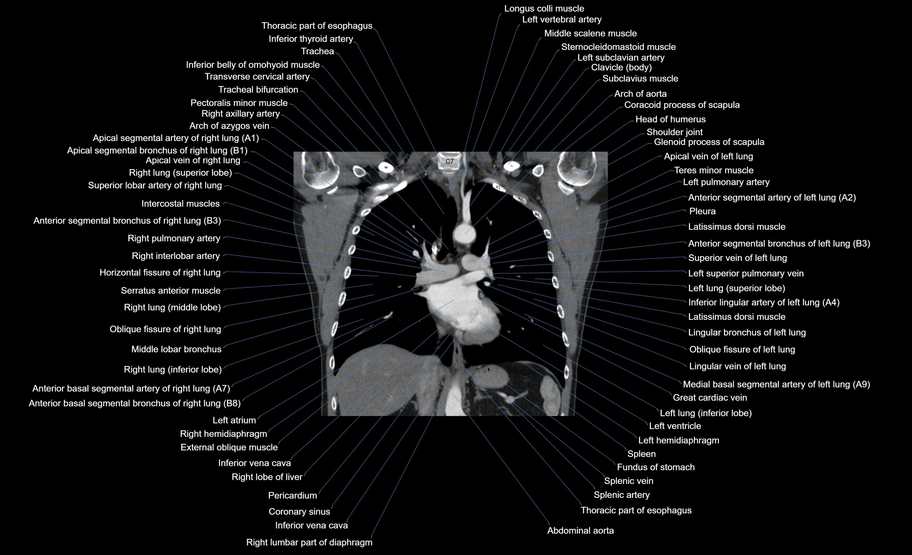 CT chest (thorax) soft tissue window labelled coronal cross sectional anatomy radiology image-00059.webp